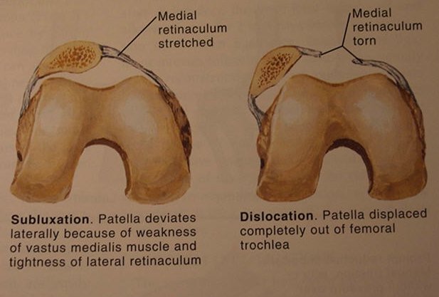 Patella Dislocation | Singapore Sports & Orthopaedic Surgeon