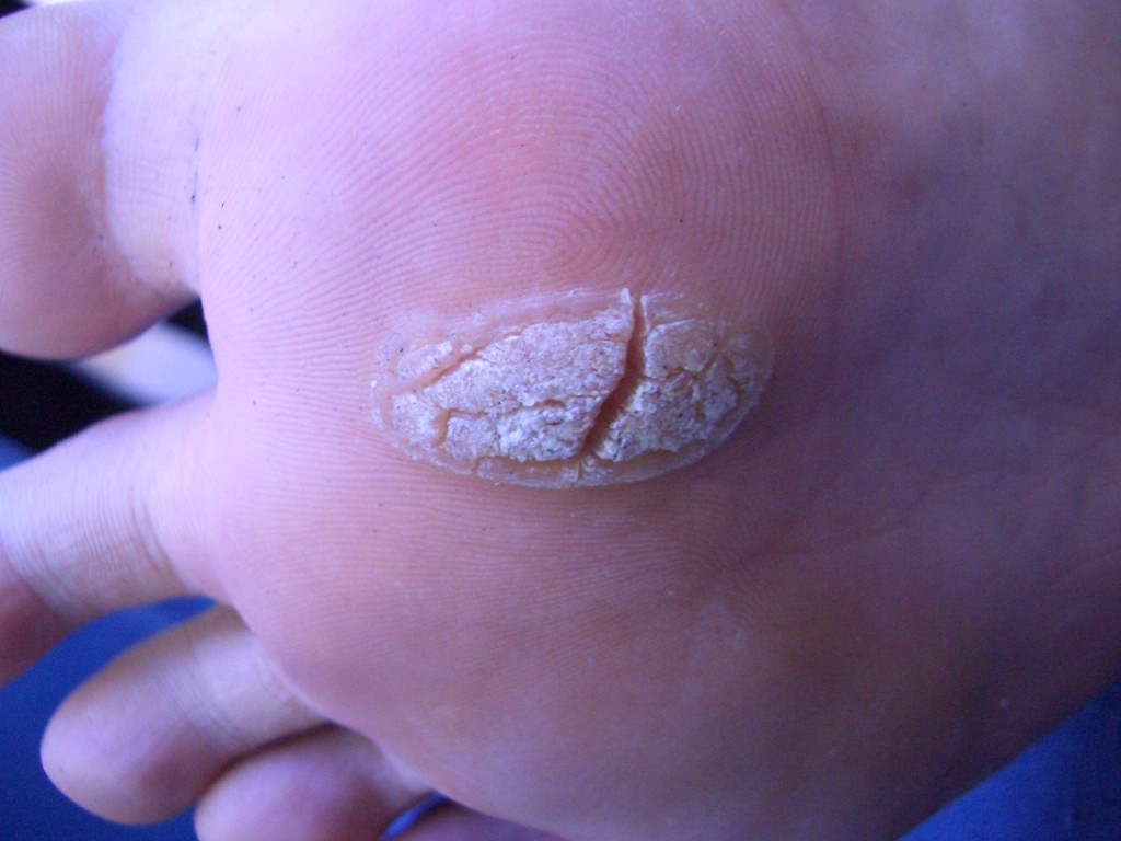 Plantar Wart Doctor Removal at Desmond Williams blog